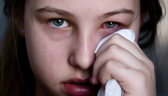 ریزش اشک بر اثر حساسیت فصلی