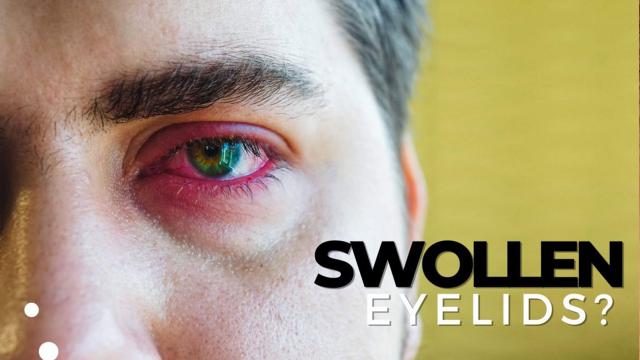 swollen-eyelids